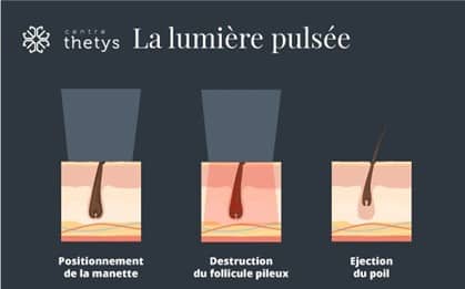 Qu'est ce que la lumière pulsée ?