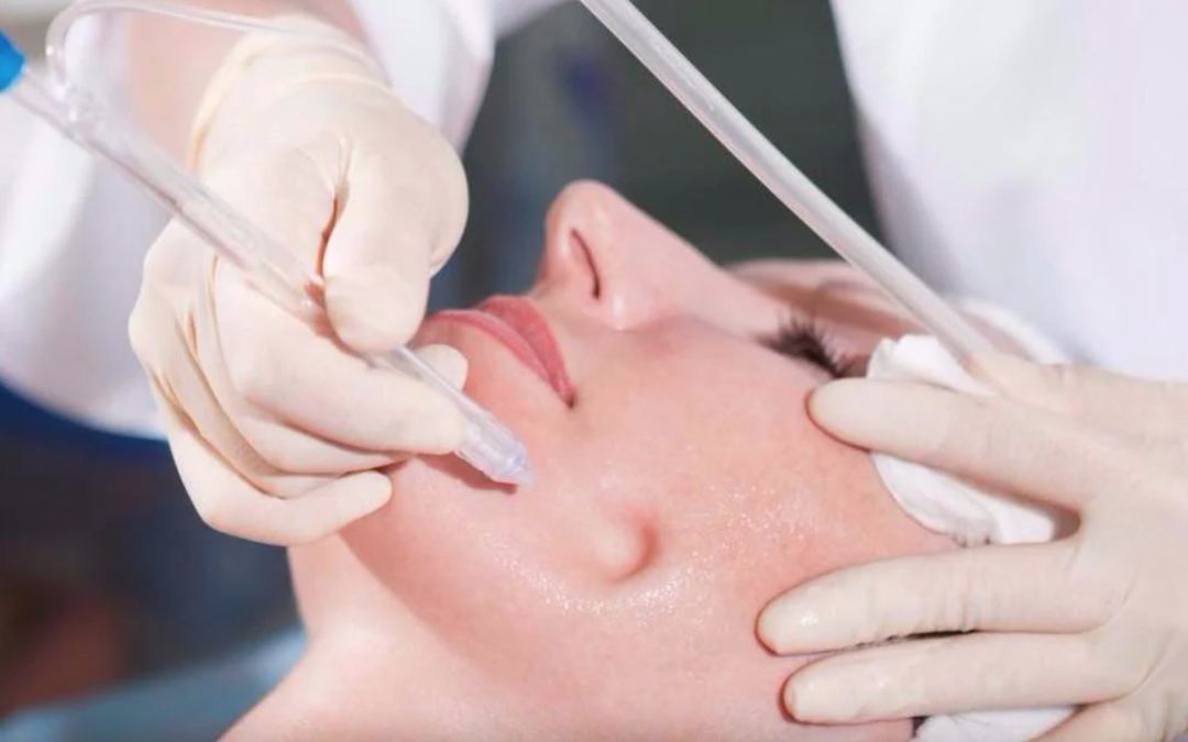 Découvrez les bénéfices du Jetpeel – Traitement esthétique haut de gamme à Cannes