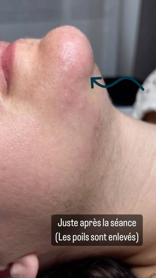 Si vous aimez vos poils au visage c’est ok ✅ 
Ou alors il y a l’électrolyse ⚡️
Pour vous débarrasser de vos poils de façon définitive 
Blanc , blond , chatain , brun …. Aucuns ne lui résiste 😉

Rdv en mp dans nos centre 
📍Antibes 
📍cannes/LeCannet 
📍Pegomas 

#epilationdefinitive #electrolyse #poilapoil #poilvisage #poilblanc #poilaumenton #poilaumentonquipoussent #institut #cire #epilation