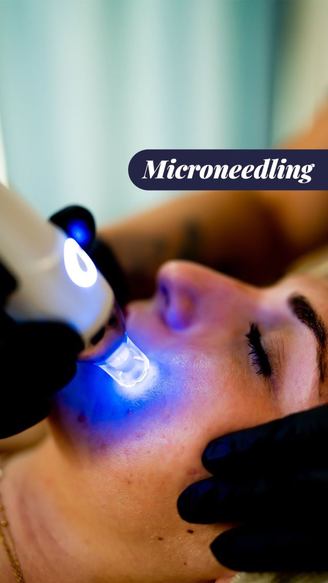 L’été approche, il est temps de revitaliser son visage avec des séances de microneedling ! 🥰

Le microneedling s’effectue à l’aide d’un stylo électrique muni de plusieurs micro-aiguilles à usage unique. Ce dispositif, permet de réaliser des micro-canaux jusqu’au derme par lesquels des principes actifs sont infusés.

Pour en savoir plus, rendez-vous sur notre site internet !

#centrethetys #technologie #antiâge #technologieexperte #expertise #centredebeauté #solutionbeauté