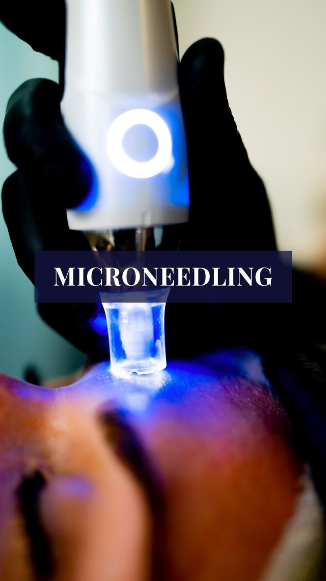 Le Microneedling permet d’agir rapidement sur les signes de l’âge. 

✅ Réduction des rides du visage, du contour des yeux et du contour des lèvres
✅ Agit sur l’aspect froissé des joues, le relâchement et les tâches brunes
✅ Agit sur les ridules de la patte d’oie, les poches, la tonicité des paupières

Votre diagnostic visage est offert, réservez le vôtre immédiatement ➡️ https://www.centrethetys.fr/prendre-rdv/

#centrethetys #soinbeauté #microneedling #rajeunissement #skincare #antiâge #rides #cotedazur #tachespigmentaires