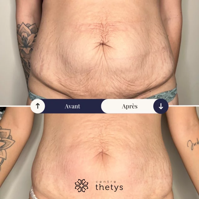✨ Résultat bluffant en fin de cure ! ✨

Voici un avant/après d’une cliente ayant suivi une cure personnalisée alliant Icoone et Radiofréquence fractionnée dans notre centre.

💠 Objectif : raffermir, lisser, redensifier la peau et améliorer visiblement la texture cutanée.
💠 Icoone stimule en profondeur la microcirculation et le drainage lymphatique pour booster la régénération cellulaire.
💠 RF fractionnée (radiofréquence) agit sur le relâchement cutané, les irrégularités et favorise la production de collagène.

📍 Résultat : une peau visiblement plus ferme, un grain de peau affiné, un vrai coup d’éclat ✨
Bravo à notre cliente pour sa régularité 💪 et merci pour sa confiance 💖

🗓️ Envie d’un diagnostic gratuit ? Contactez-nous en MP ou prenez RDV sur www.centrethetys.fr

#icoone #radiofrequence #soinvisage #avantapres #centrethetys #beautetechnologique #antibes #cannes #pegomas #skincare #antiage