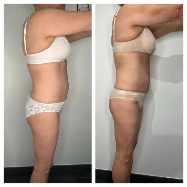 ✨ Résultats visibles, transformation incroyable ✨
Chez Centre Thetys, nous ne promettons pas la magie… mais des résultats concrets et visibles dès les premières semaines.

Cette cliente a choisi de nous faire confiance pour affiner sa silhouette, raffermir sa peau et retrouver un ventre plus plat et tonique.
Grâce à notre technologie V-CORE, qui combine travail musculaire intense et remodelage profond, elle a pu retrouver une silhouette redessinée, une peau visiblement plus lisse, et une posture plus ferme.

💬 Son retour ?
« Je sens mon corps plus tonique, plus fort, et je rentre à nouveau dans mes vêtements préférés ! »

🔹 Résultats naturels
🔹 Aucune chirurgie
🔹 Accompagnement personnalisé tout au long du parcours

➡️ Vous aussi, offrez à votre corps un coup de boost en profondeur.
📍 Rendez-vous dans l’un de nos centres à Antibes, Cannes ou Pégomas pour une évaluation offerte.

#CentreThetys #Transformation #Silhouette #VCore #AntiAge #Minceur #AvantAprès #EsthétiqueTechnologique #RemiseEnForme #CorpsTonic