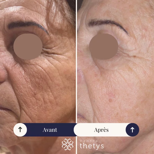 ✨ Résultats visibles, peau revitalisée !

Voici le témoignage en image de l'efficacité de nos séances de radiofréquence anti-âge.

💆‍♀️ Sur cette photo, vous pouvez observer une nette amélioration de :
✔️ La fermeté de la peau
✔️ La diminution des rides et ridules
✔️ Le relâchement au niveau de l'ovale du visage
✔️ L’éclat du teint

🌟 Grâce à la technologie de la radiofréquence, nous réactivons naturellement la production de collagène pour une peau plus lisse, plus tonique et visiblement rajeunie.

💉 Sans chirurgie, sans douleur et avec des résultats dès les premières séances !

📍Disponible dans nos centres à Antibes, Cannes et Pégomas.
📩 Contactez-nous en message privé pour un diagnostic offert et découvrir si ce soin est adapté à votre peau.

#Radiofréquence #AntiÂge #AvantAprès #SoinVisage #Rajeunissement #EsthétiqueAvancée #CentreThetys #BeautéTechnologique #PeauFermeté #GlowNaturel #SoinNonInvasif