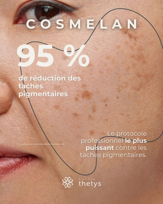 Les taches pigmentaires racontent souvent une histoire : soleil, hormones, stress, temps…
Mais elles ne sont pas une fatalité.

Grâce au protocole Cosmelan, nous agissons à la source du déséquilibre pigmentaire pour éliminer jusqu’à 95 % des taches et révéler un teint plus lumineux.✨

Une solution professionnelle, sûre et durable, disponible dans vos centres Thetys.
Votre peau mérite l’harmonie.🤍

#centrethetys #antitache #tachespigmentaires #cosmelan #soinantitaches #masquedegrossesse #melasma #mesoesthetic #tachesoleil #glowyskin #solutionbeauté #soinvisage #solutiontaches