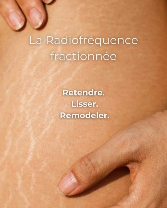 La radiofréquence fractionnée stimule le collagène en profondeur pour une peau plus ferme et plus lisse.
Une technologie de pointe pour retendre, lisser et redessiner le corps naturellement.

Réservez votre Diagnostic offert des maintenant (lien en bio).

#vergetures #peauferme #peaulisse #radiofréquence #raffermissement